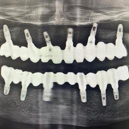 https://admin.realteethclinic.com/uploads/implant_53b16e6f5a.webp